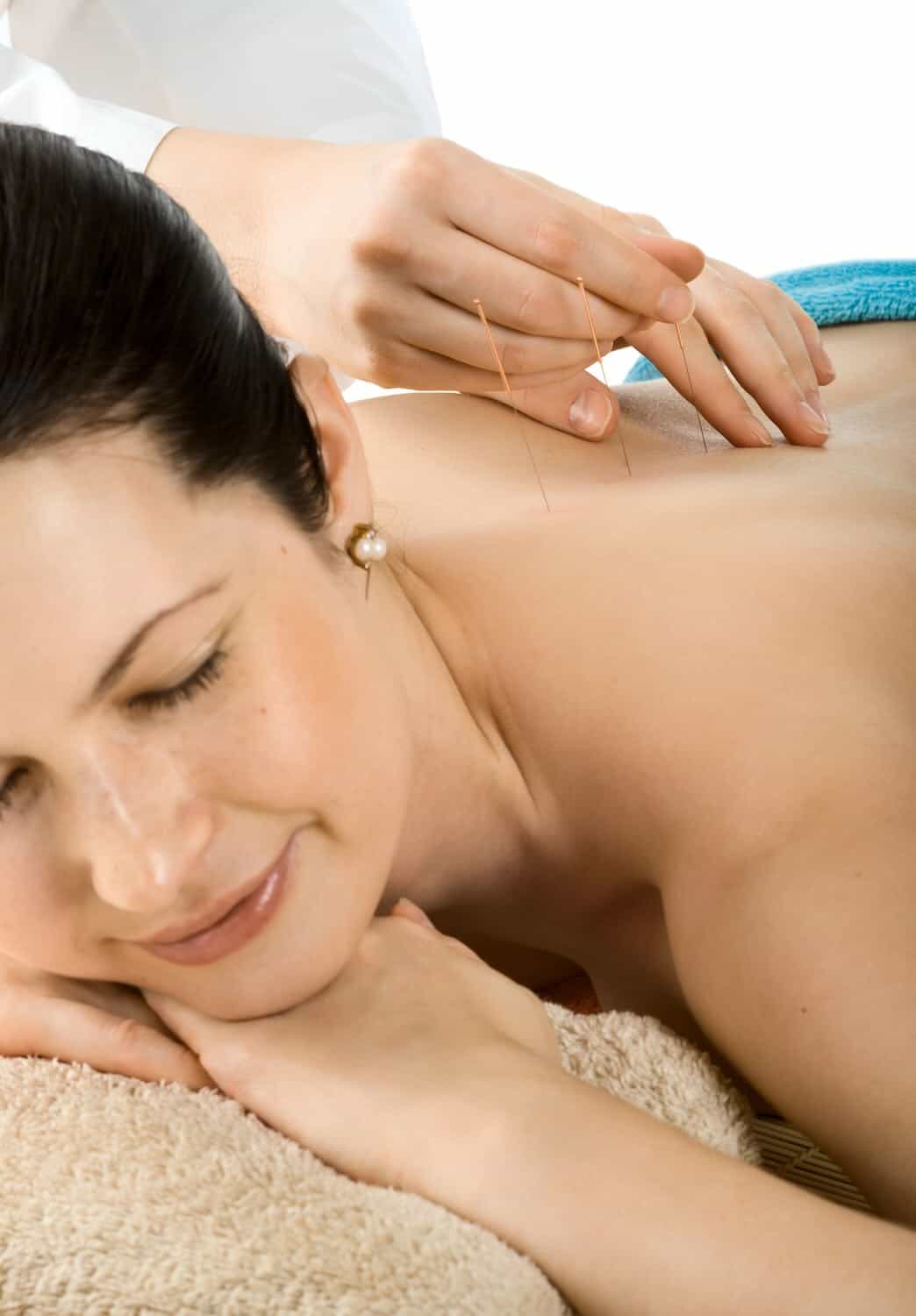 acupuncture